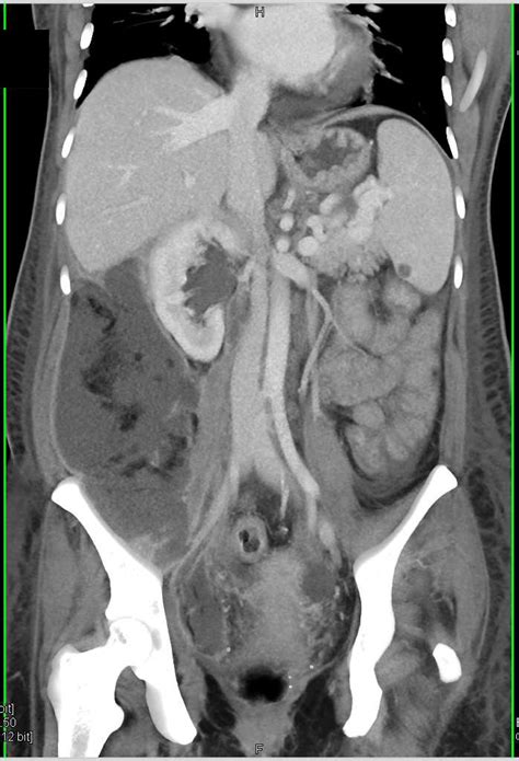 Perforated Appendix With Abscess Colon Case Studies Ctisus Ct Scanning