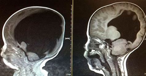 Escáner cerebral mostró que un estudiante universitario no tenía cerebro
