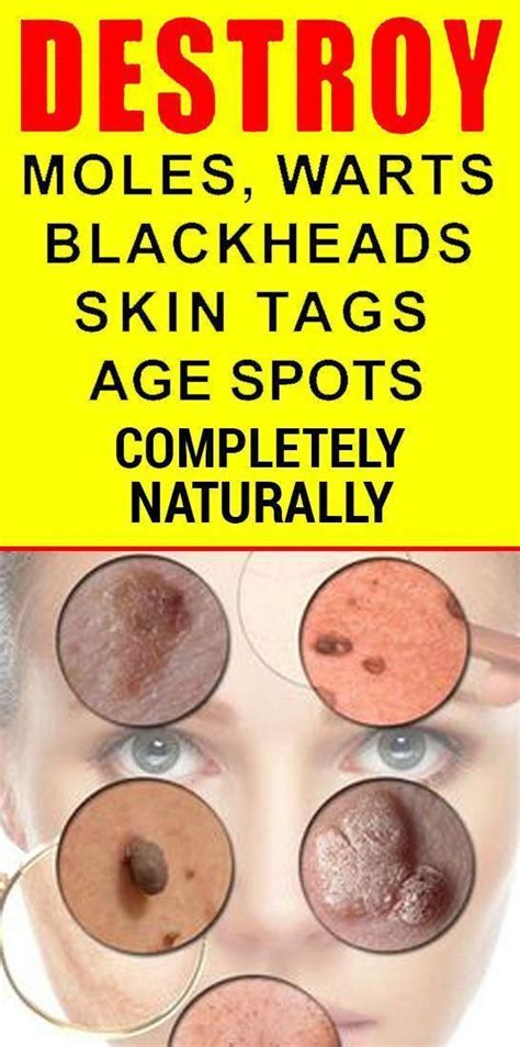 how to remove moles warts blackheads skin tags and age spots completely naturally skin