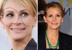Julia Roberts Plastic Surgery Was Executed Well