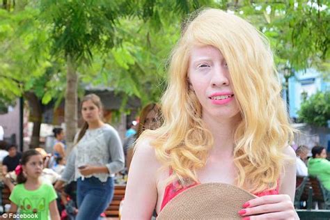 Being Different Is A Blessing Albino Mexican Model Challenges Beauty Standards By Embracing