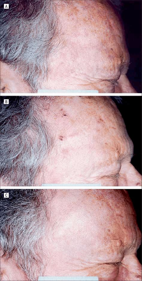 Resolution Of Actinic Keratosis Ak Lesions After Treatment With 5