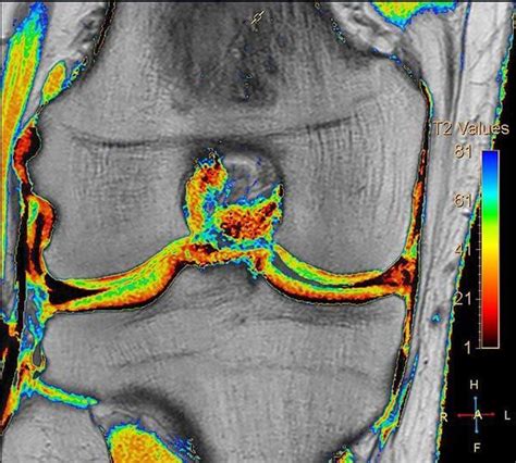 Figure Shows T2 Mapping Of The Knee Articular Cartilage Medizzy
