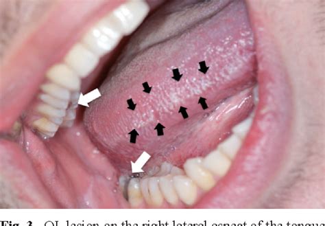 Figure 3 From Oral Leukoplakia Associated With Amalgam Restorations