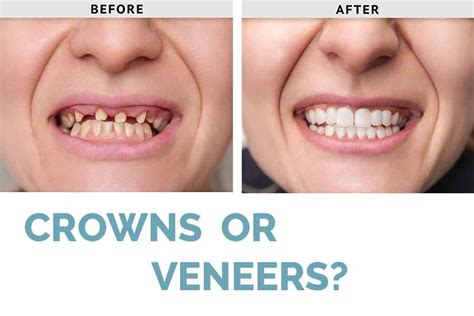 Difference Between Crown And Veneer Renew Physical Therapy