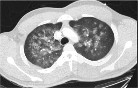 Ct Scan Of Chest Showing Bilateral Infiltrates Download Scientific