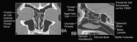 The Frontal Sinus Drainage Pathway And Related Structures American Journal Of Neuroradiology