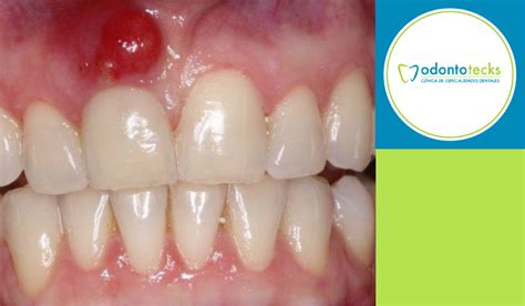 Absceso Dental Causas Y Síntomas Odontotecks