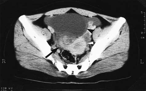 Paraovarian Cyst With Torsion In Children Journal Of Pediatric Surgery