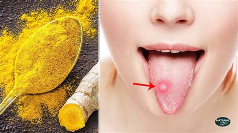 How To Get Rid Of Bumps On Tongue Canker Sore Youtube