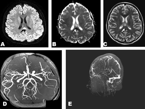 Magnetic Resonance Imaging Mri Brain Magnetic Resonance Angiography