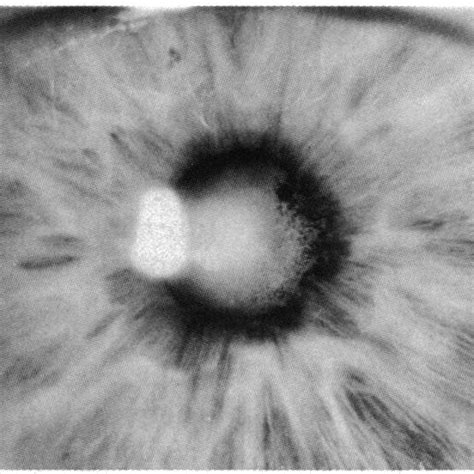 Causes Of Iris Pigment Epithelial Loss Pigment Epi­ Thelial Loss