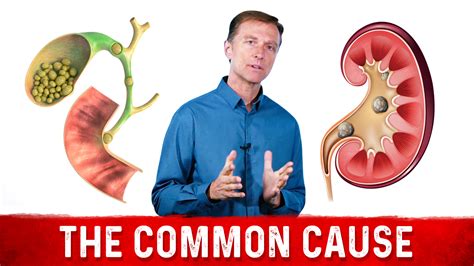 Recycled waste we recycle 38+ tons of waste annually Gallstones vs Kidney Stones A Common Cause | Dr.Berg Blog