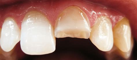 Fracturas Dentales ¿qué Hacer Ante Una Fractura Dental Urgencias