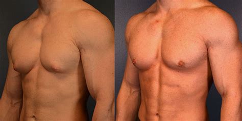 Male Breast Reduction Gynecomastia In St Louis