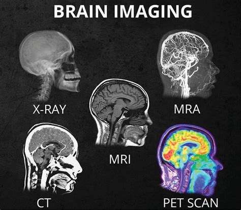 What S The Difference Between All The Different Head Scans X Ray CT MRI MRA PET Scan