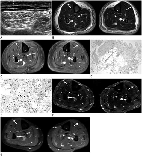 A Case Of Eosinophilic Fasciitis Imaging Findings From Early Diagnosis