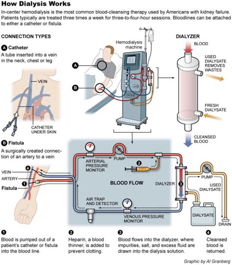 Medical School • Infographic On How Dialysis Works