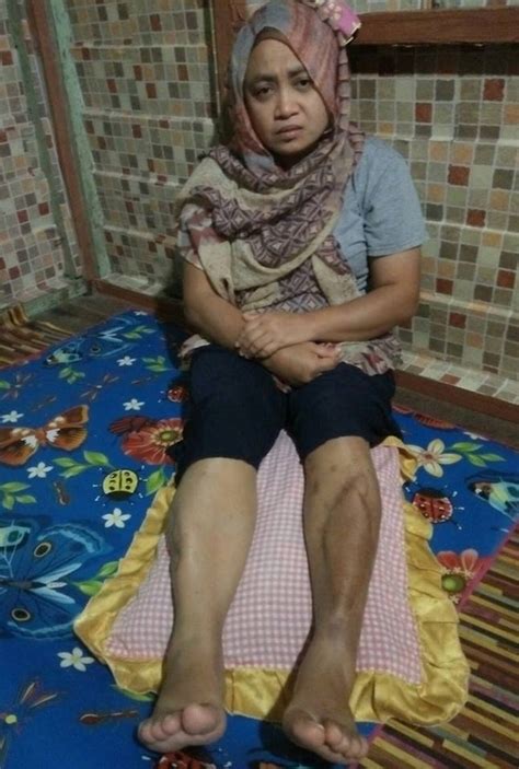 Tanya dokter seputar kesehatan dan penyakit bersama tim kami di klikdokter. 'Tulang kering kaki kiri terpaksa dipotong, hampir 2 tahun ...