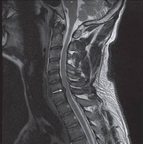 An X Ray View Of The Back Of A Persons Neck