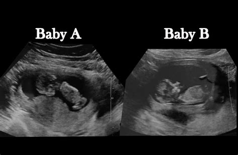 12 Week Ultrasound Of Twins Taken On 7 9 18 Noobienikon Flickr