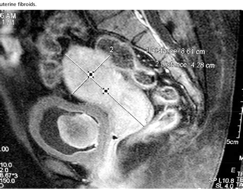 Figure 2 From Bladder Leiomyoma Presenting With Luts And Coexisting
