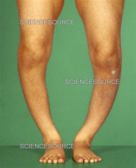 Rickets Stock Image Science Source Images