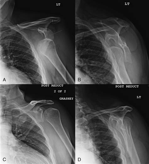 Glenohumeral Joint Dislocation Classification Literature Re