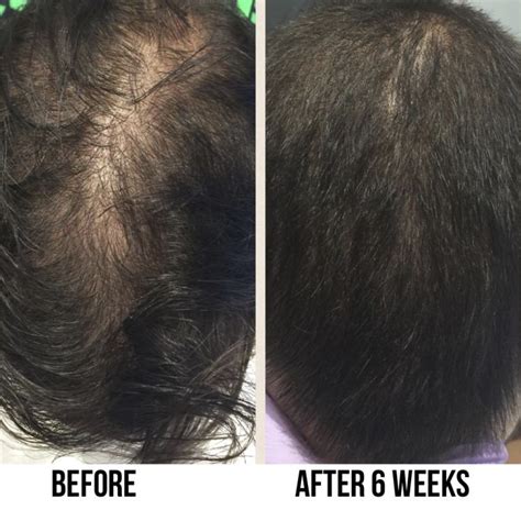 By now, many people know that men can buy shampoo with an ingredient called minoxidil. New Hair Restoration Treatments -- EstheticaMD | PRLog