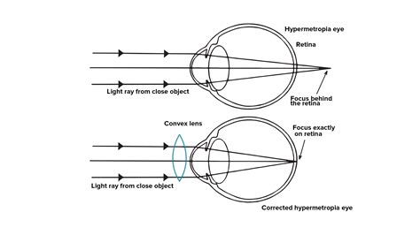 when do we consider a person to be myopic or hypermetropic explain using diagrams how the
