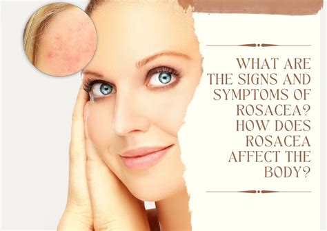 What Are The Signs And Symptoms Of Rosacea How Does Rosacea Affect The
