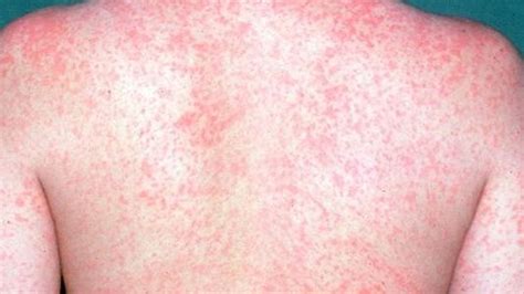 Officials 30 Measles Cases In Western Washington Outbreak