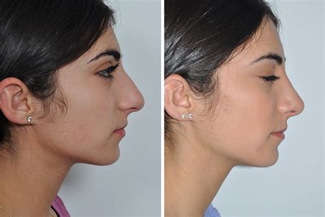 Rhinoplasty or nose job is a surgical procedure to change the shape/size of the nose, performed by some of the most experienced surgeons in the uk at the harley medical group. Rhinoplasty 148 | David Rosenberg, M.D., PLLC