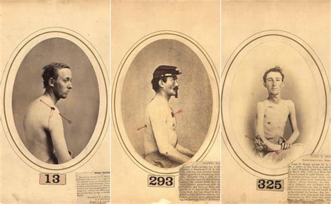 Photographs Of Wounded Civil War Soldiers Taken By New York Surgeon