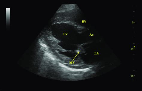 Point Of Care Ultrasound Pocus Cardiac Imaging Parasternal Long Axis
