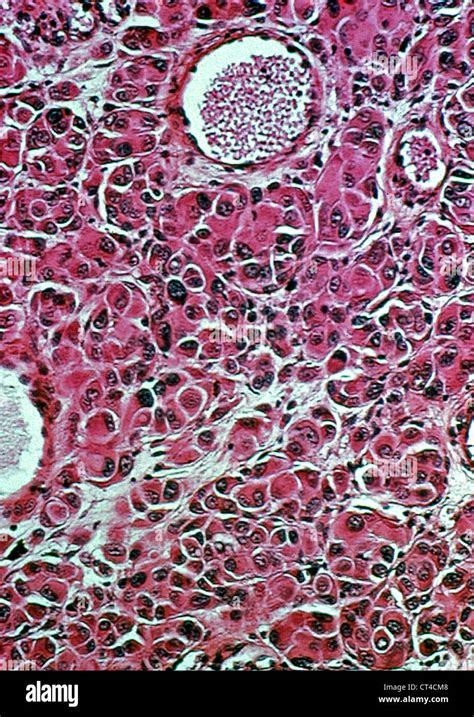 Melanoma Histology Stock Photo Alamy