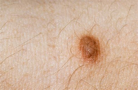 A Dermatofibroma Type Of Mole In The Skin Stock Image M2200019