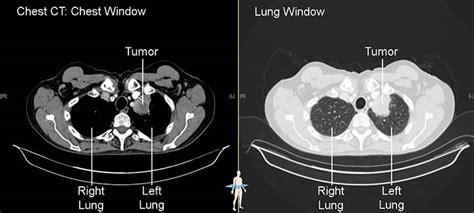 Imaging Tests Lungevity Foundation