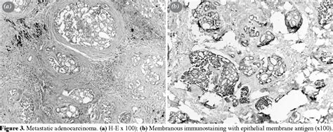 Pdf Epithelial Membrane Antigen In Differential Diagnosis Of