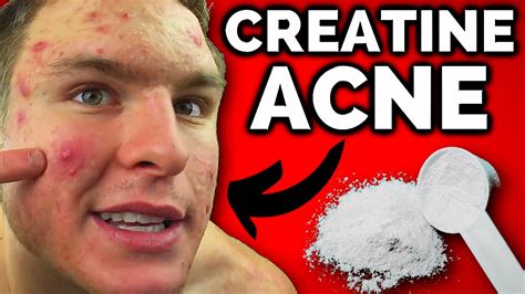 Does Creatine Cause Acne FINALLY SOME ANSWERS YouTube
