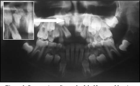 Figure 1 From Dentigerous Cyst Associated With Inverted And Fused
