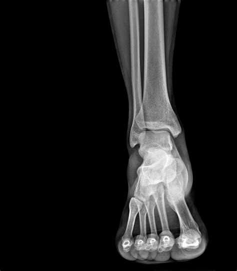Foot X Ray Arthritis Joeryo Ideas