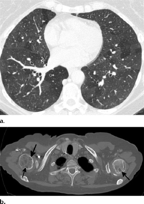 Mosaic Attenuation In A 41 Year Old Woman With Shortness Of Breath A