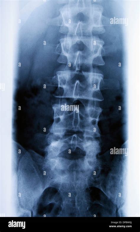 La Radiografía De La Columna Lumbar Fotografía De Stock Alamy