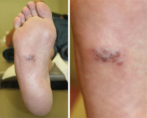 A Year Old Man With A Painful Rash On The Sole Of His Foot