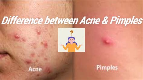 Difference Between Acne And Pimples Beauty Tips Youtube