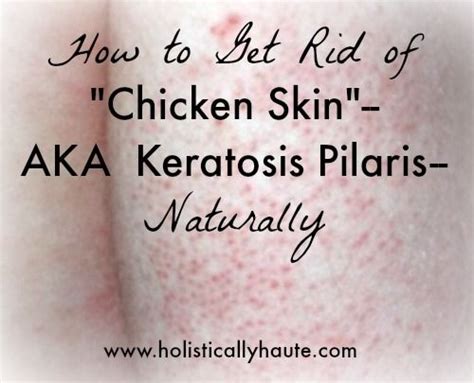 How To Get Rid Of Chicken Skin Aka Keratosis Pilaris Naturally