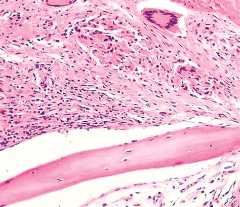 Pathology Outlines Tuberculous Osteomyelitis