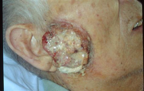 Malignant Lesions Squamous Cell Carcinoma Scc Picture