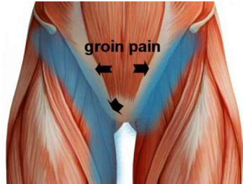 The gracilis originates from the pubic ramus of your pelvis near your pubic symphysis. WHAT IS YOUR GROIN PAIN? - RHP Physiotherapy